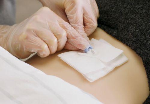 Verbandstoffe für Ernährungssonden Verbandstoffe für Ernährungssonden